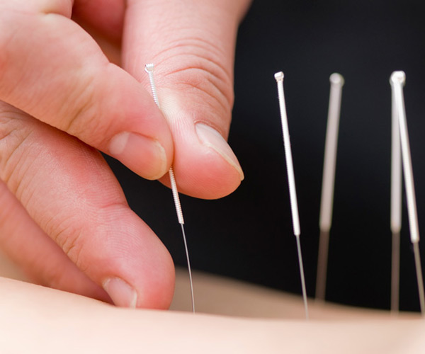 soleus-dryneedling-dry needling-ims-600-500